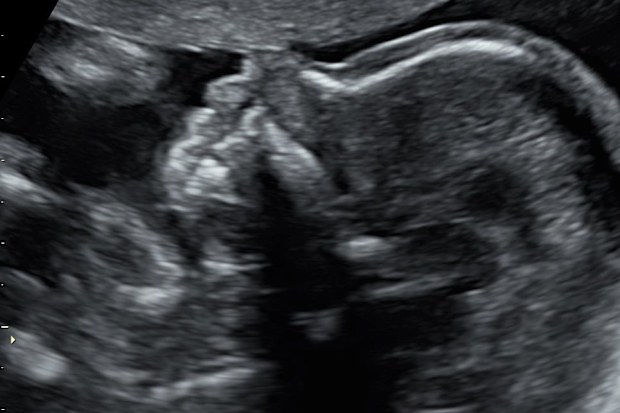 An early scan on Harper revealed something wasn't right.