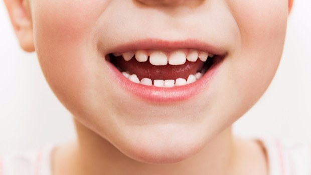 Tooth decay in South Australian kids is on the rise. (iStock)