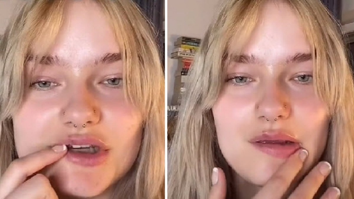 Woman shares dramatic Botox 'fail': 'Horror story' | Nine.com.au
