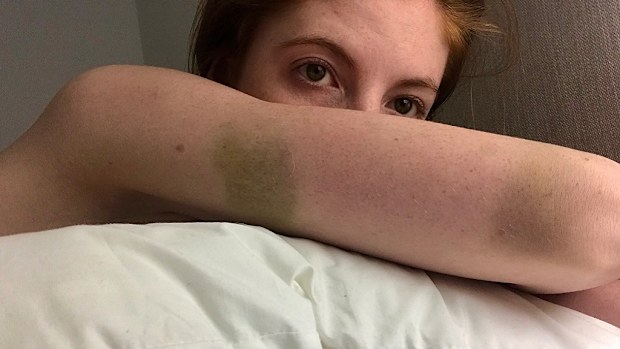 Tamara bruises