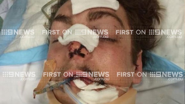 Jake Stephenson, 21, was placed into an induced coma following the 'one-punch' attack. (9NEWS)