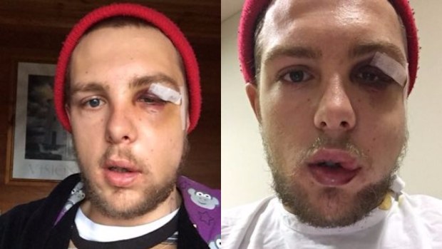 Kyle, 23, was the victim of a one punch attack by a security guard. (9NEWS)
