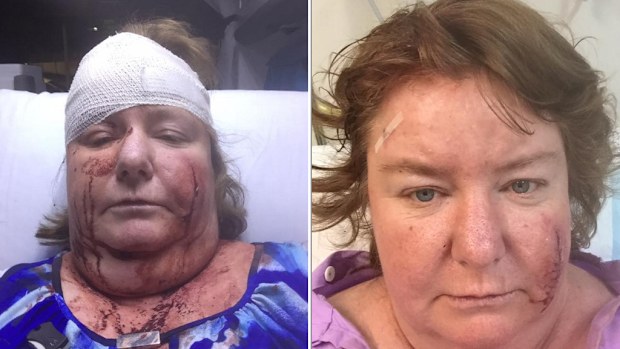 The woman posted images of her injuries to Facebook. 
