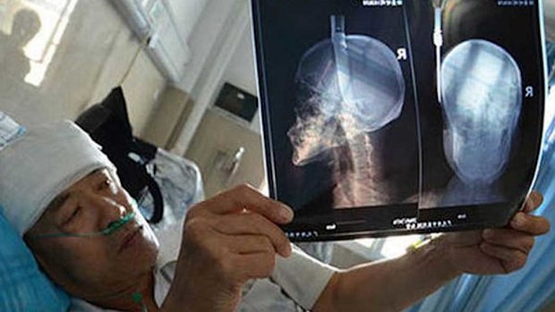 Yunzhi Xiao, 57, shows an X Ray of the impalement. (Twitter)