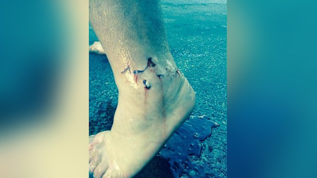The paddle-boarder was bitten on the ankle. (Supplied)
