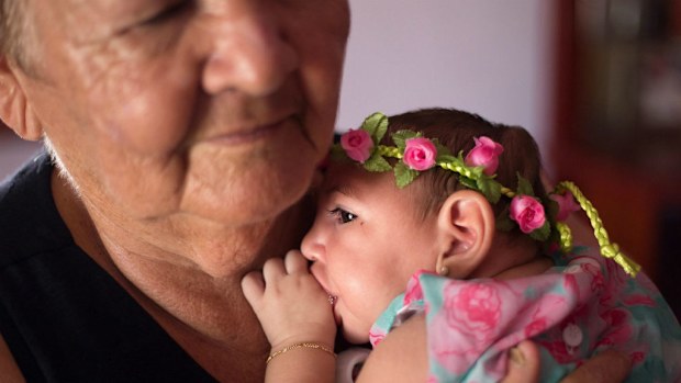 Zika can cause birth defects, including the brain and skull deformity known as microcephaly. (AAP)
