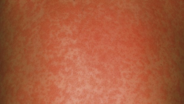 The total number of measles cases in Melbourne has now reached 14. (Getty)