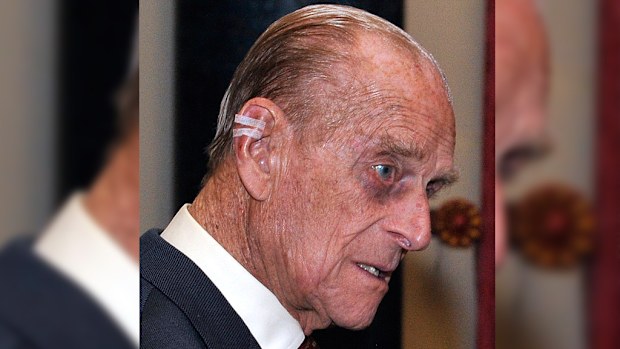 The Duke of Edinburgh and his rather painful-looking black eye. (Getty)
