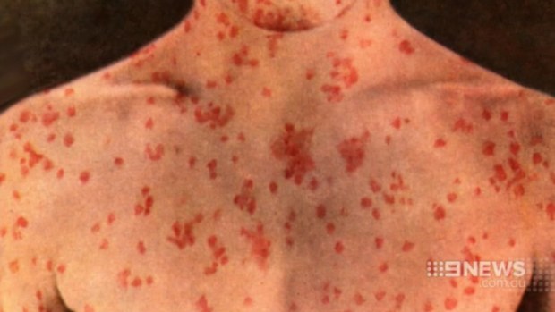A measles rash. (9NEWS)