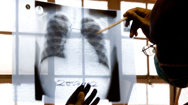 Researches in the US say they have developed a speedier and more accurate way of diagnosing TB. (AAP)