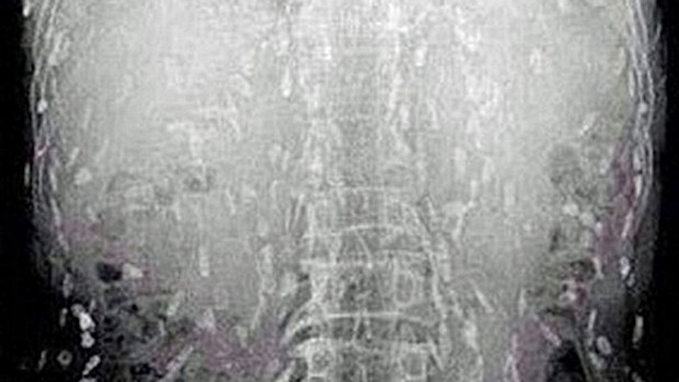 The man presented to doctors with a stomach ache and itchy skin. (East Network News)