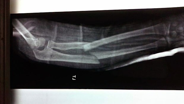 The x-ray of the young boy's broken arm. (AAP)