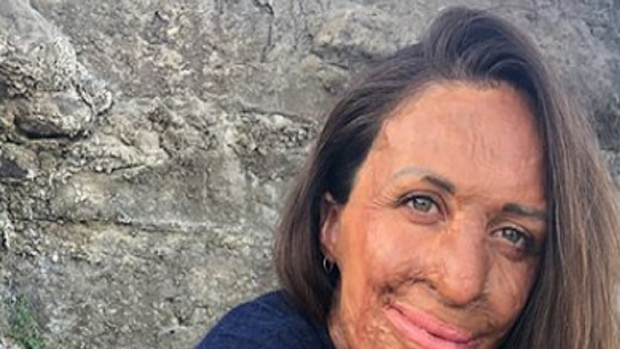 Turia Pitt sitting outdoors
