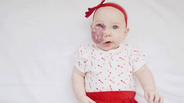 Mother Katie Crenshaw used her blog to speak out to comments on her daughters birthmark. (Katie Crenshaw/ Instagram)
