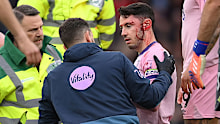 Adam Smith of Bournemouth receives treatment after clashing heads with Tyler Adams.