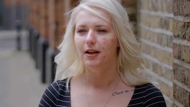 Hannah has severe skin condition on Embarrassing Bodies on 9Now