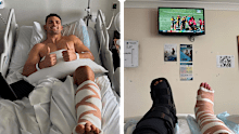 Nathan Cleary now has both legs in a cast.