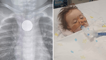 Amity had to undergo emergency surgery to remove the button battery.