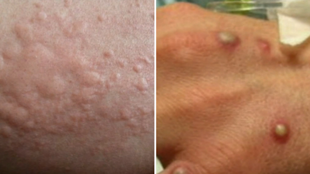 Queensland has detected a fifth case of the monkeypox virus.