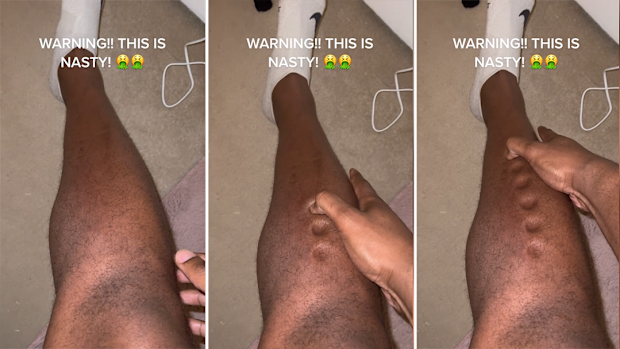 Former British Olympian Lawrence Okoye posted this video of a 'nasty' skin condition.