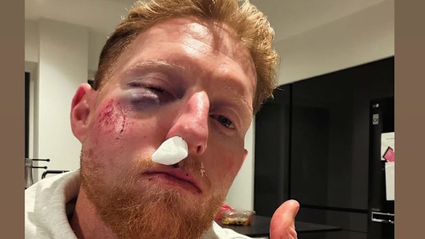 Ben Stokes takes to Instagram, revealing the extent of his facial injury.