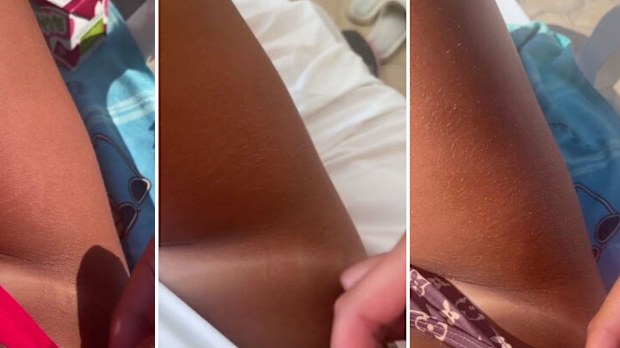 barbie drug melanotan Experts lash use of popular social media sun tanning drug Melanotan