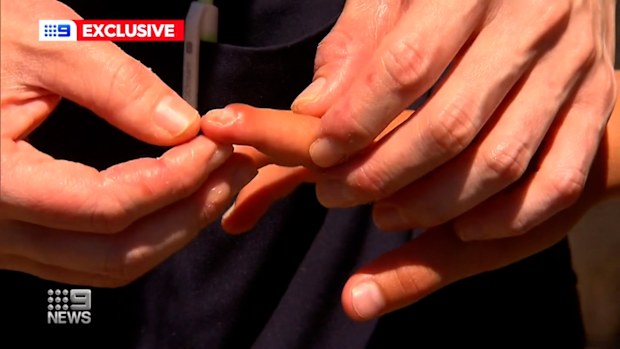 Leeches are sometimes used in surgeries where blood is getting into the part but not coming out. 