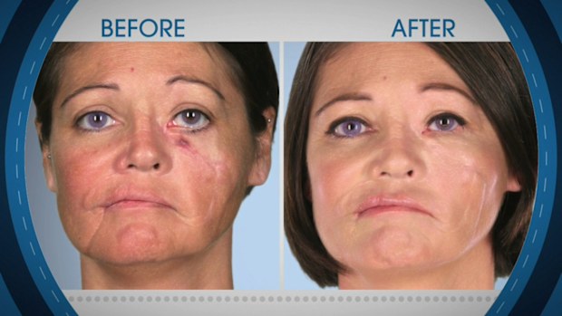 Botched 9Now