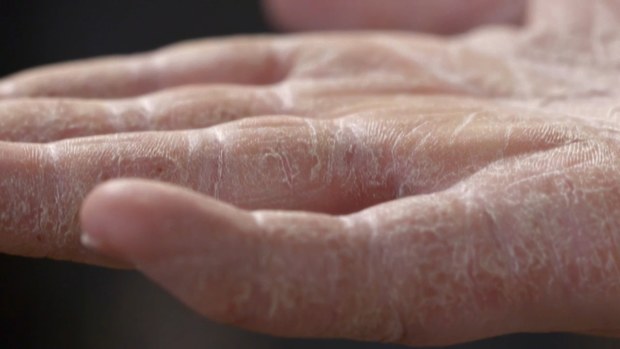 Dr Pimple Popper on 9Now - Tyler cracked dry hands