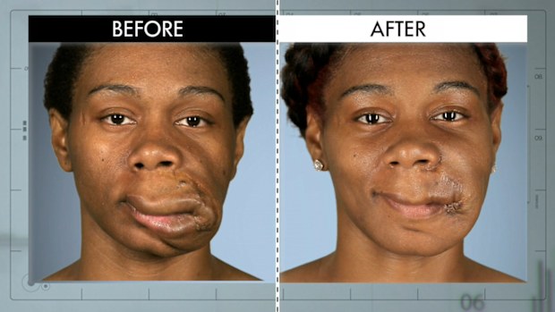 Starrina's before and after shots are unbelievable on Botched. 