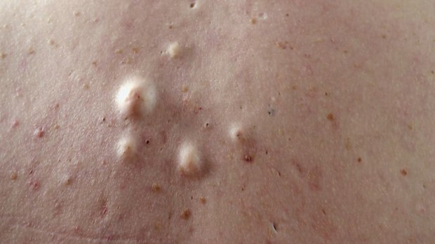Bad Skin Clinic, 9Now
