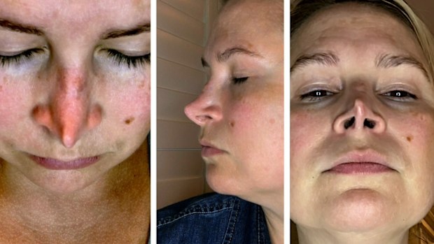 After one surgery, Holly was left with a Botched nose job.