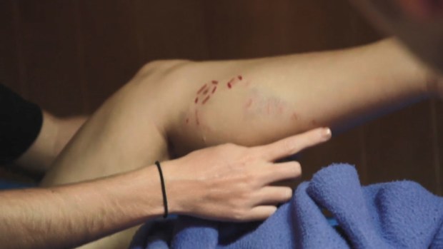 Melissa reveals her wounds after being bitten by an American crocodile.