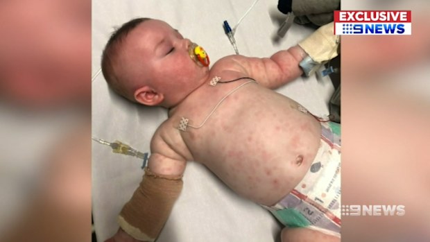 Just days ago, six-month-old Oliver was fighting for his life after being struck down with Meningococcal B.
