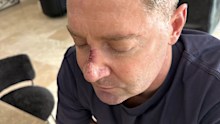 Michael Clarke skin cancer