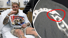 Jake Paul shows an X-ray of his broken jaw