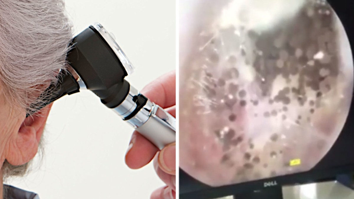 Doctor finds mushroom-like fungal growths in man’s ear | Nine.com.au