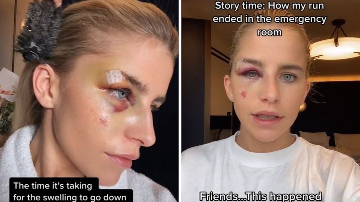 German influencer Caroline Daur reveals horror injury after running ...