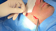 Michael Genovese – 9News Perth Presenter - has an operation to treat a Basal Cell Carcinoma. 