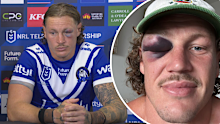 Kurt Mann shows off blackeye after Bulldogs victory against Dragons.