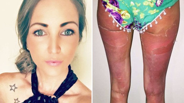Briar Houston said she was at the beach for less than two hours and reapplied her Banana Boat sunscreen after swimming.