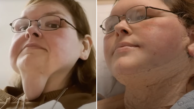 Tammy Slaton surgery before and after
