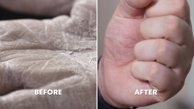 Dr Pimple Popper on 9Now - Tyler cracked dry hands
