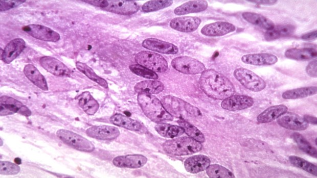 Chickenpox is responsible for thousands of deaths each year.