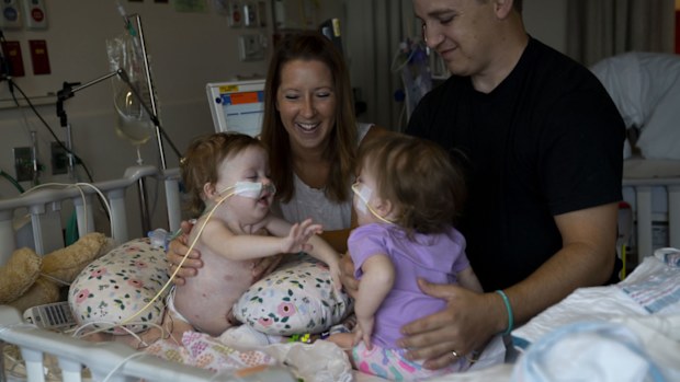 Michigan conjoined twins separated
