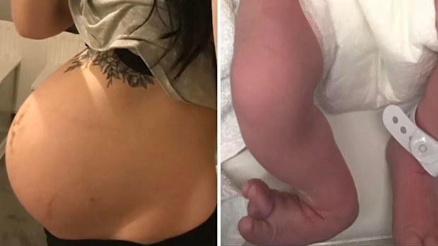 Bethany Love shares photo of baby's misshapen feet that were stuck under her rib cage