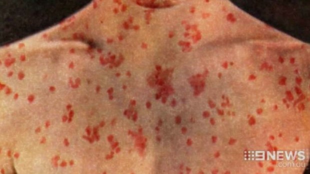 A measles alert has been issued for Brisbane. (9NEWS file image)
