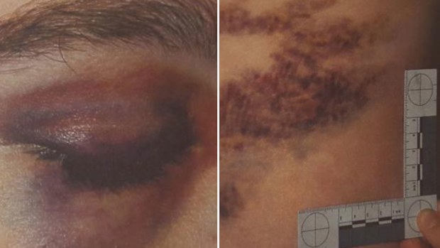 The severe injuries left the victim in hospital for days (SA Police).