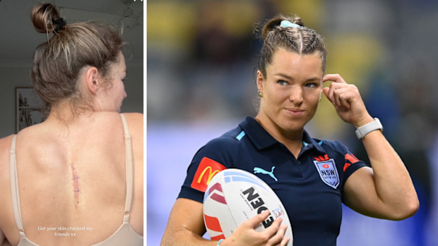 Emma Verran (nee Tonegato) shares an image of the scare on her back. 