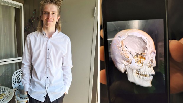 Kane Valentine, pictured before his accident, and (right) a computer-generated image showing the damage to his skull.